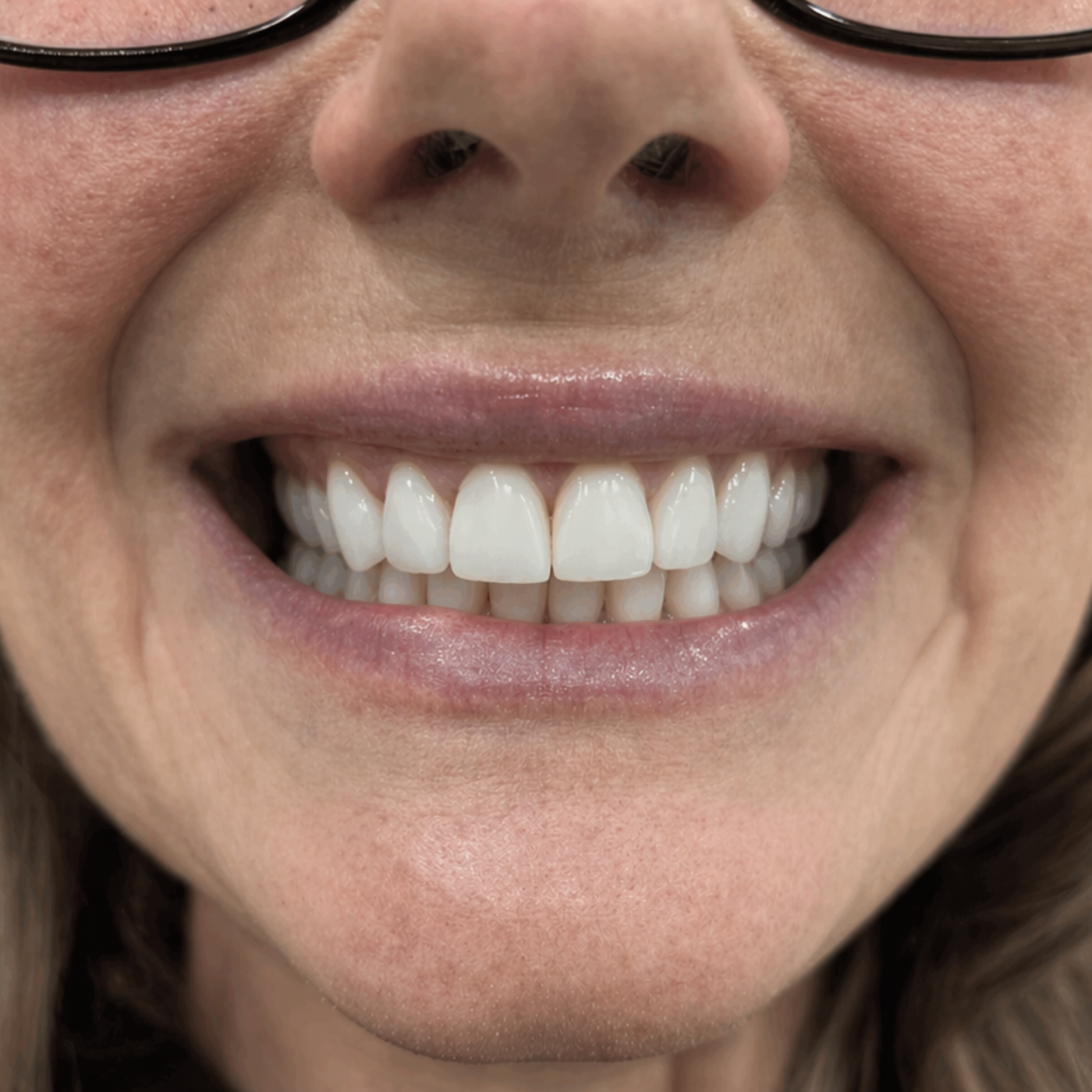 Visibly whiter teeth after using Velia