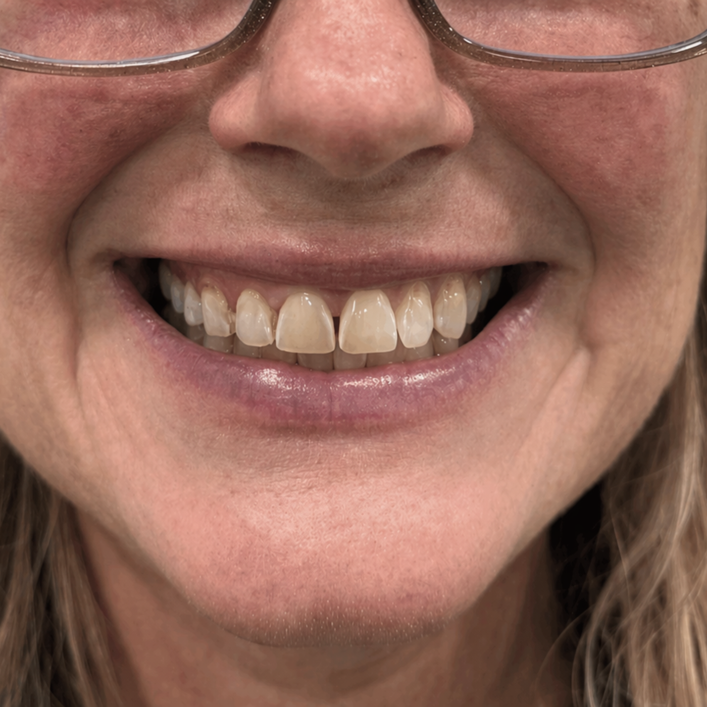Teeth before using Velia