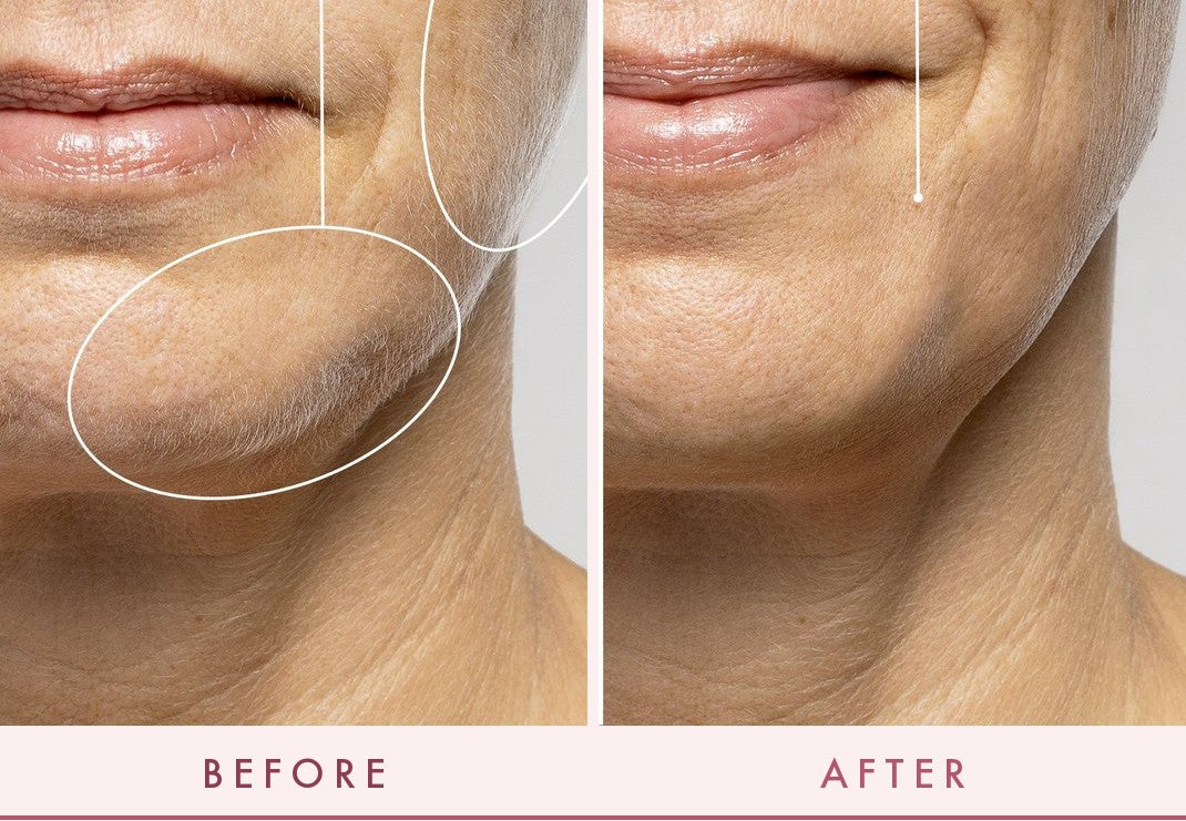 Before and after: smoother, brighter skin with FLERMIX